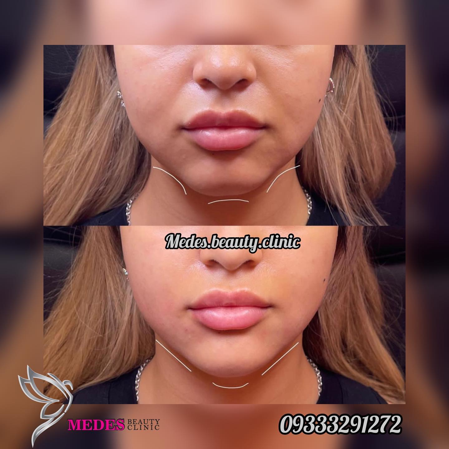 گالری زاویه سازی صورت